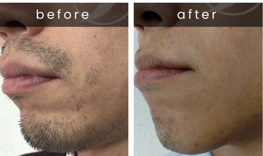 男性のヒゲ脱毛をした施術前と施術後の比較写真